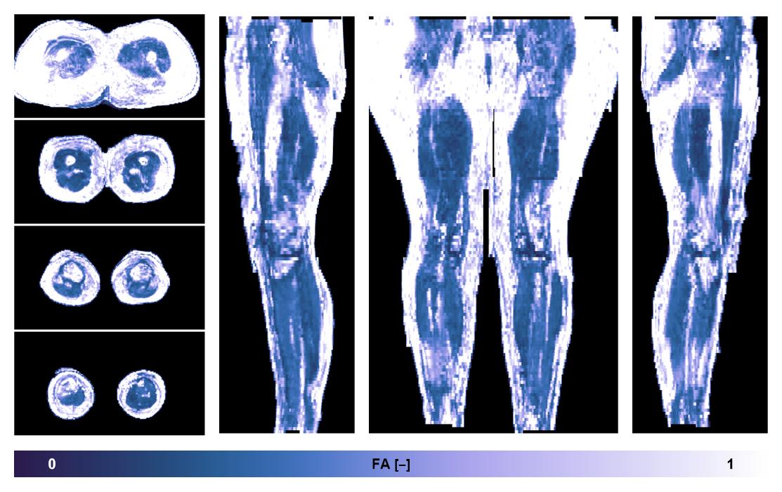 IVIM corrected whole leg muscle fractional anisotropy obtained from diffusion tensor imaging.